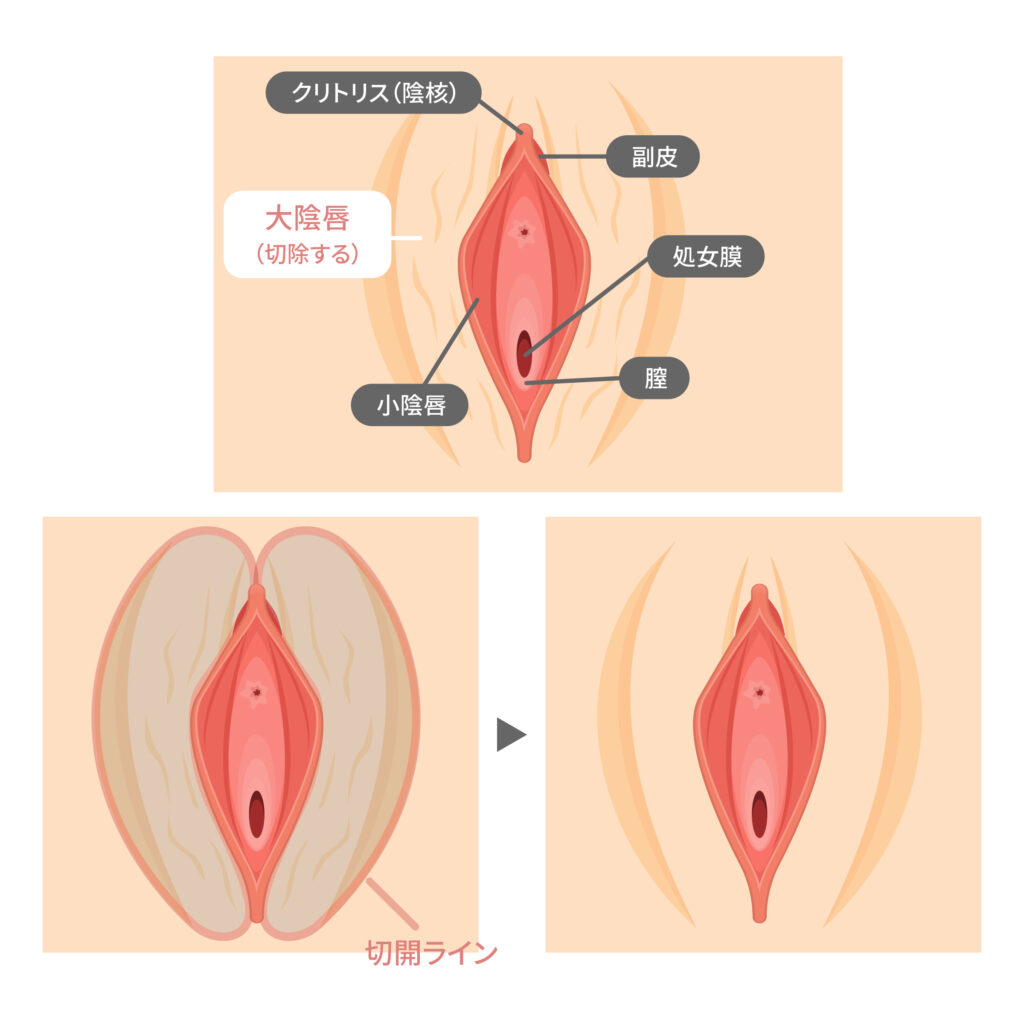 クリトリス 大きく