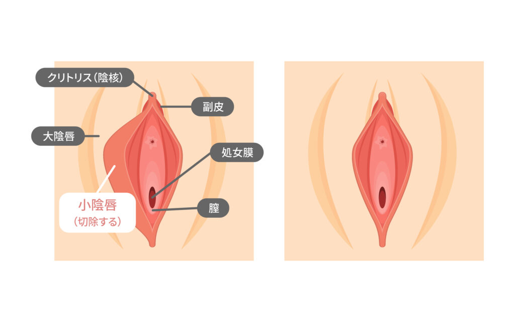 小唇陰　画像 東京中央美容外科